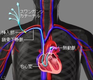 肺動脈圧を計るために、鎖骨下静脈からスワンガンツカテーテルを挿入し、心臓内を通し測定している様子の図