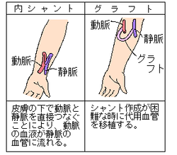 イラスト：内シャント・グラフト