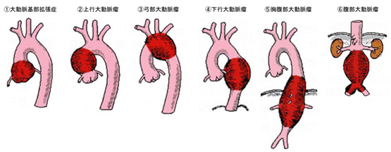 大動脈瘤と大動脈解離 病気について 循環器病について知る 患者の皆様へ 国立循環器病研究センター病院