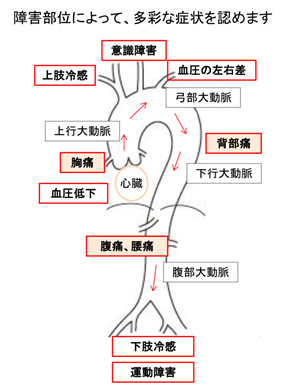 解離 スタンフォード b 大動脈