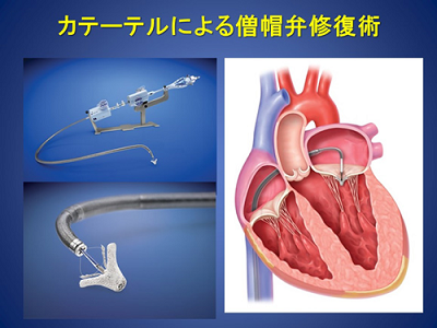 症 心臓 手術 弁膜 術後の患者さんからの質問とその回答｜心臓血管外科手術について｜心臓血管外科特設サイト｜医療法人徳洲会名古屋徳洲会総合病院
