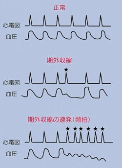 図２：心電図でみる血圧の波
