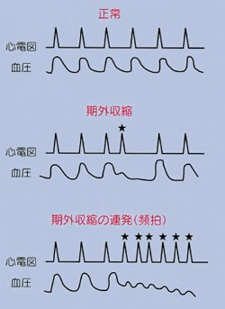 性 期 頻発 収縮 性 心室 外