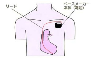 図５：心臓ペースメーカーのしくみ