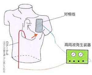 図６：カテーテルアブレーションのしくみ