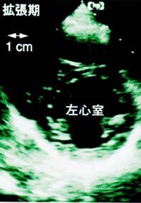 写真1の1:健常な心臓の超音波エコー像(拡張期)