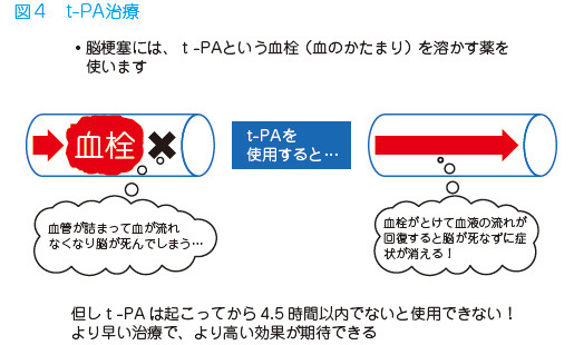 脳 梗塞 予防 薬