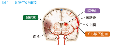 脳幹 出血