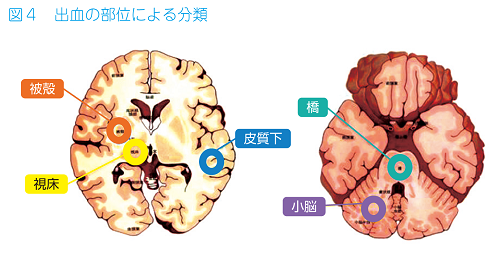 Images of 脳出血 - JapaneseClass.jp