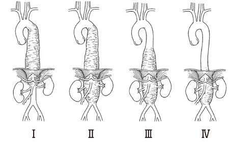 アダム キュー ビッツ 動脈