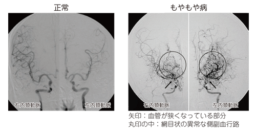 117 もやもや病 ここまできた診断 治療 脳 循環器病あれこれ 国立循環器病研究センター 循環器病情報サービス