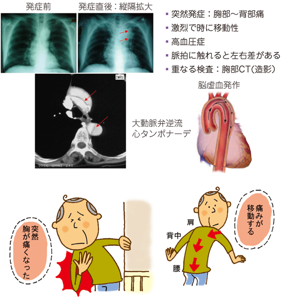 左 胸 した の 痛み