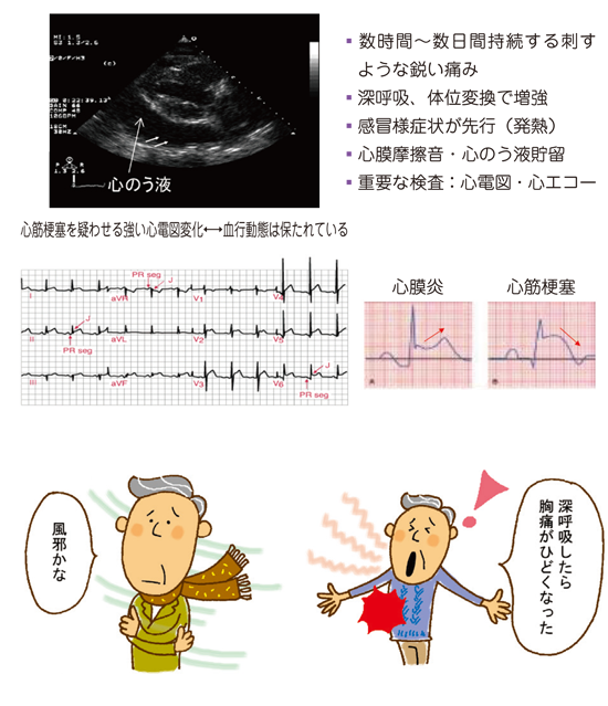 左 胸 の 痛み