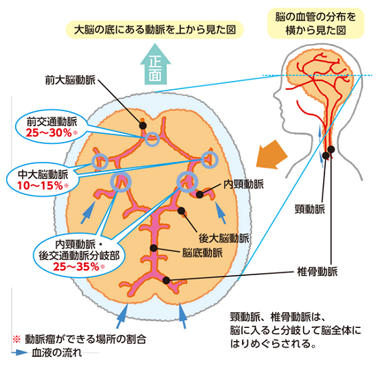 132 未破裂脳動脈瘤が見つかったら 最近の進歩 脳 循環器病あれこれ 国立循環器病研究センター 循環器病情報サービス