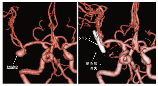 脳 動脈 瘤 消える