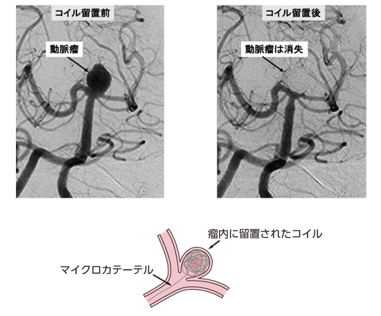 破裂 脳 動脈 瘤