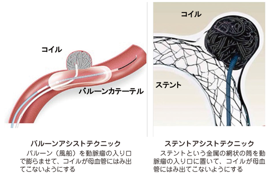 脳 動脈 瘤 消える