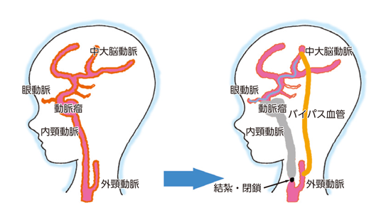 動脈 瘤 消える 脳 脳動脈瘤について知っておきたいこと