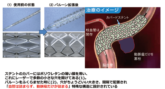 脳 動脈 瘤 消える