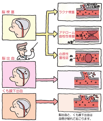 の 病気 種類 脳