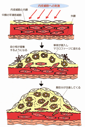 動脈 硬化 と は