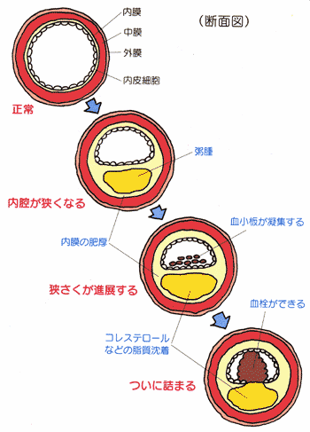 動脈 硬化 と は