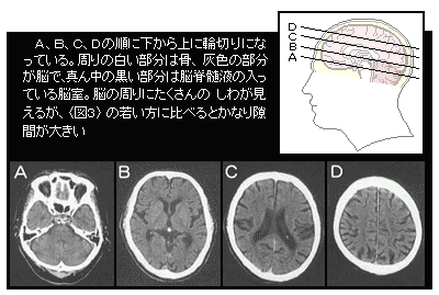 28 脳の画像検査で何がわかる 脳 循環器病あれこれ 国立循環器病研究センター 循環器病情報サービス