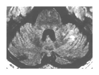 図４：めまいだけの脳硬塞のMRI(拡散強調画像)