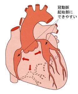 31 川崎病のはなし 小児の心臓病 循環器病あれこれ 国立循環器病研究センター 循環器病情報サービス