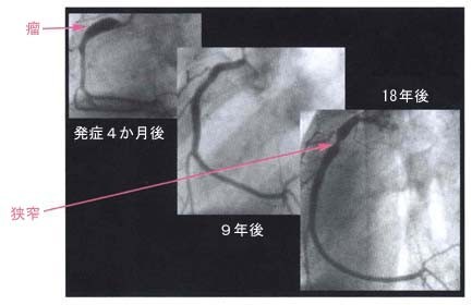 31 川崎病のはなし 小児の心臓病 循環器病あれこれ 国立循環器病研究センター 循環器病情報サービス