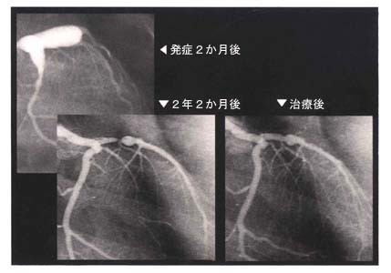 31 川崎病のはなし 小児の心臓病 循環器病あれこれ 国立循環器病研究センター 循環器病情報サービス