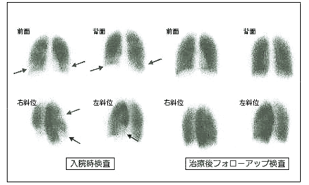 グラフィー ガリウム シンチ ガリウムシンチグラフィとは？画像診断のポイントは？