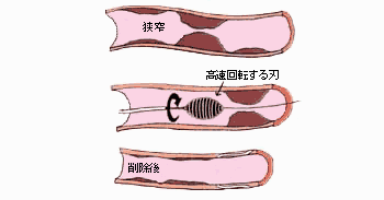 図9:動脈硬化切除術(ロタブレーター)