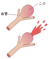 図1:脳動脈瘤とその破裂