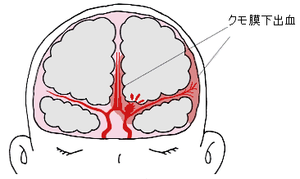 図2:クモ膜下出血の様子