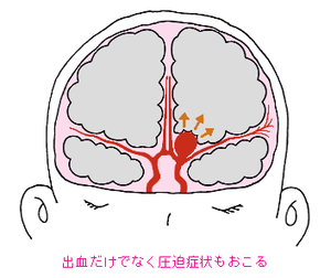 図5:巨大脳動脈瘤