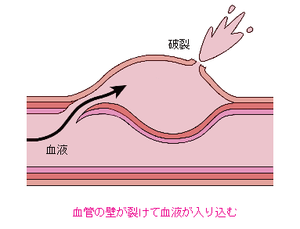 図6:解離性脳動脈瘤