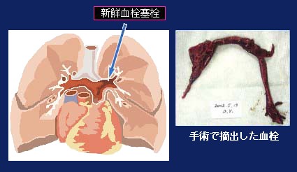 エコノミー クラス 症候群 症状