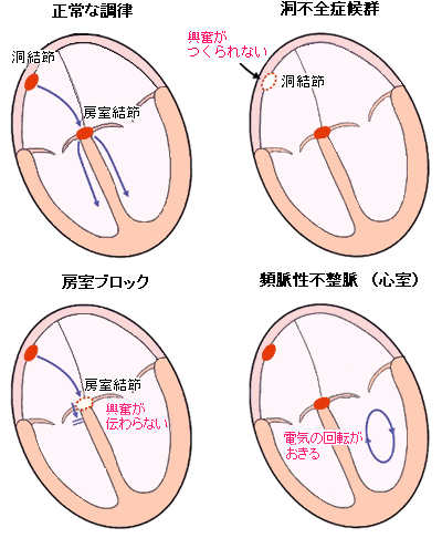 47 ペースメーカーと植え込み型除細動器 心臓 循環器病あれこれ 国立循環器病研究センター 循環器病情報サービス