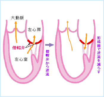 図5:僧帽弁形成術で血液の逆流を減らす