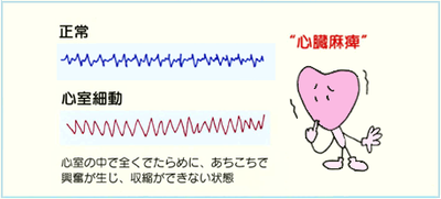 図3:心臓発作直後に見られる危険な不整脈