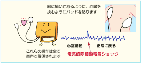 図4:電気的除細動電気ショック