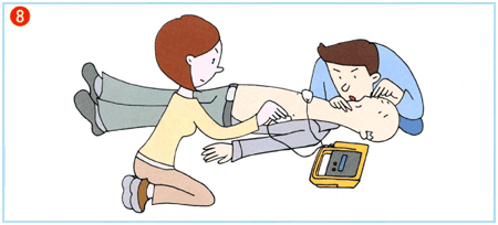 イラスト:(8)電極パッドを患者さんの胸に貼ります