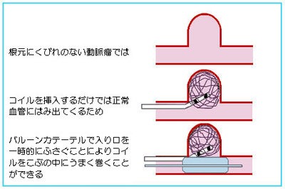 56 脳血管のカテーテル治療 脳 循環器病あれこれ 国立循環器病研究センター 循環器病情報サービス