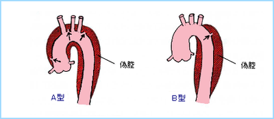 図４：大動脈解離の分類（スタンフォード分類）