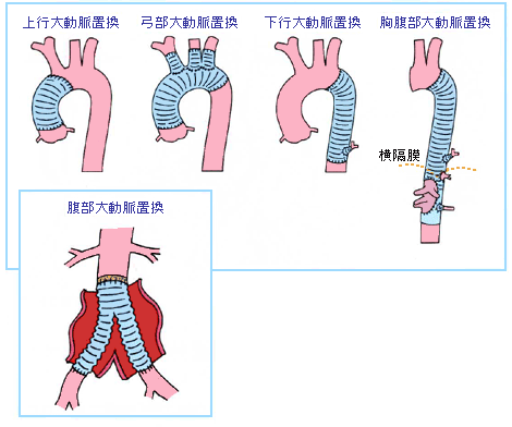 図５：部位別人工血管置換術