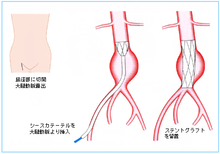 図６：ステントグラフト治療