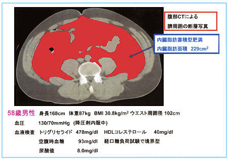 図４：メタボリックシンドロームの典型例
