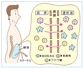 図4:透析を24時間行える腹膜透析