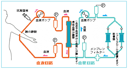 図6:冠動脈疾患を防ぐ「LDLアフェレーシス療法」